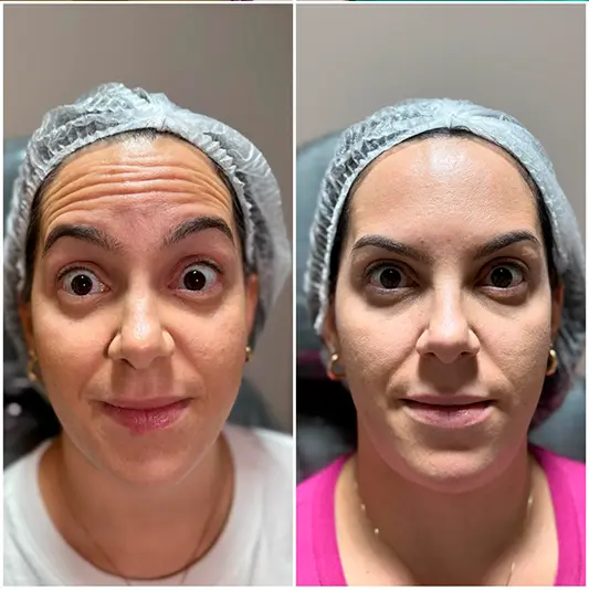 Botox