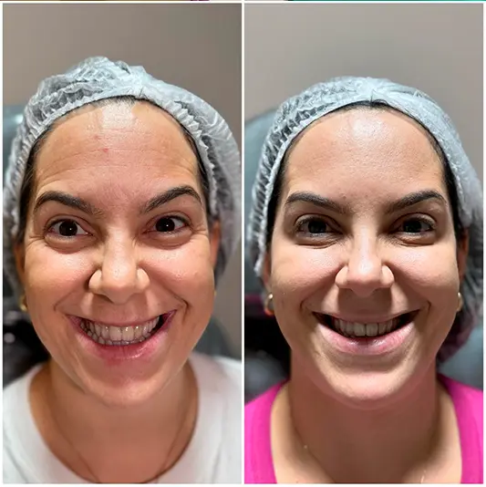 Botox