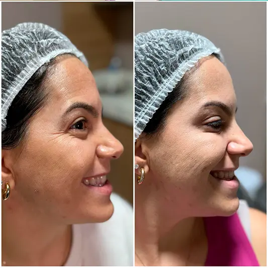 Botox