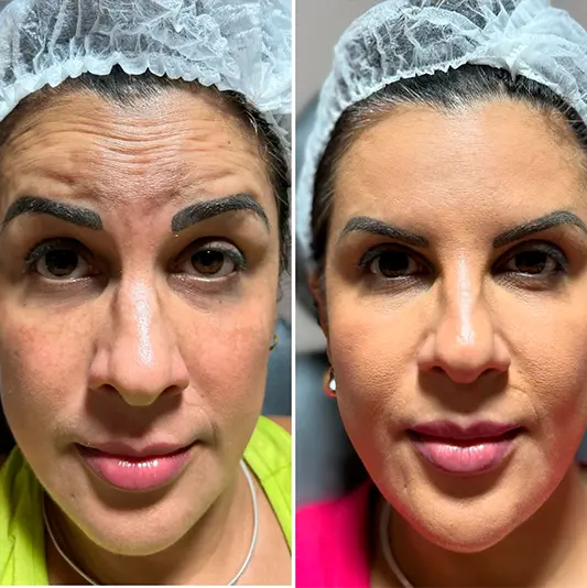Botox