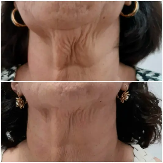 Botox