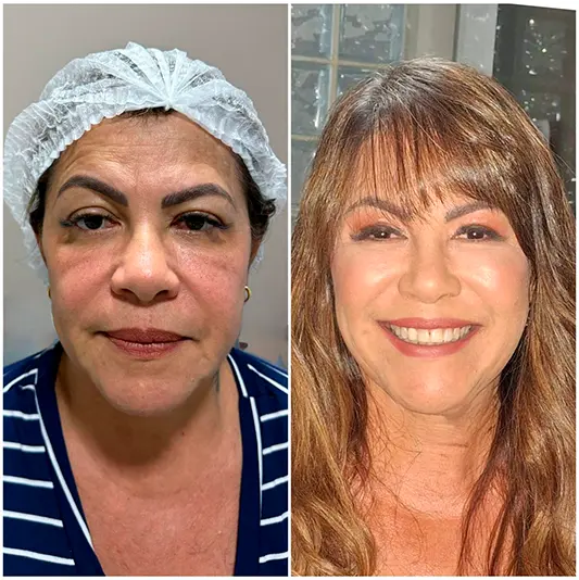 Harmonização Facial