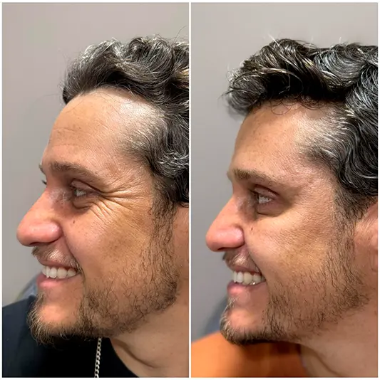 Botox